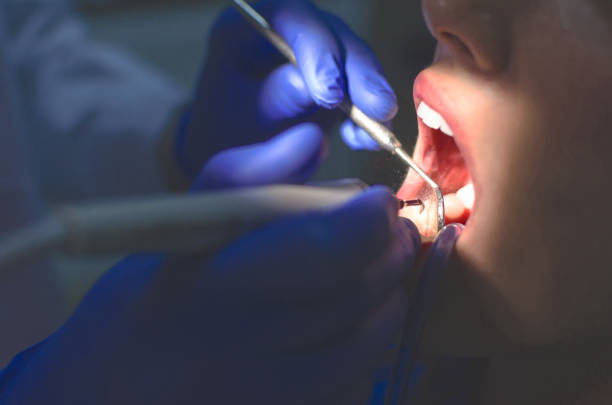 Close up of stone removal procedure at female patient.